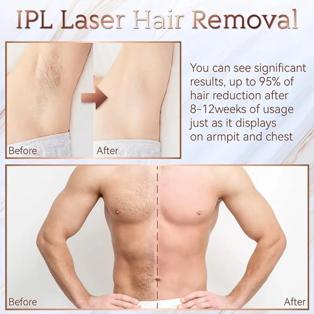 Bare-Allure IPL Device